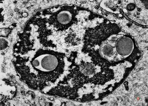 F,52y. | bone marrow - inclusions in plasmocytes